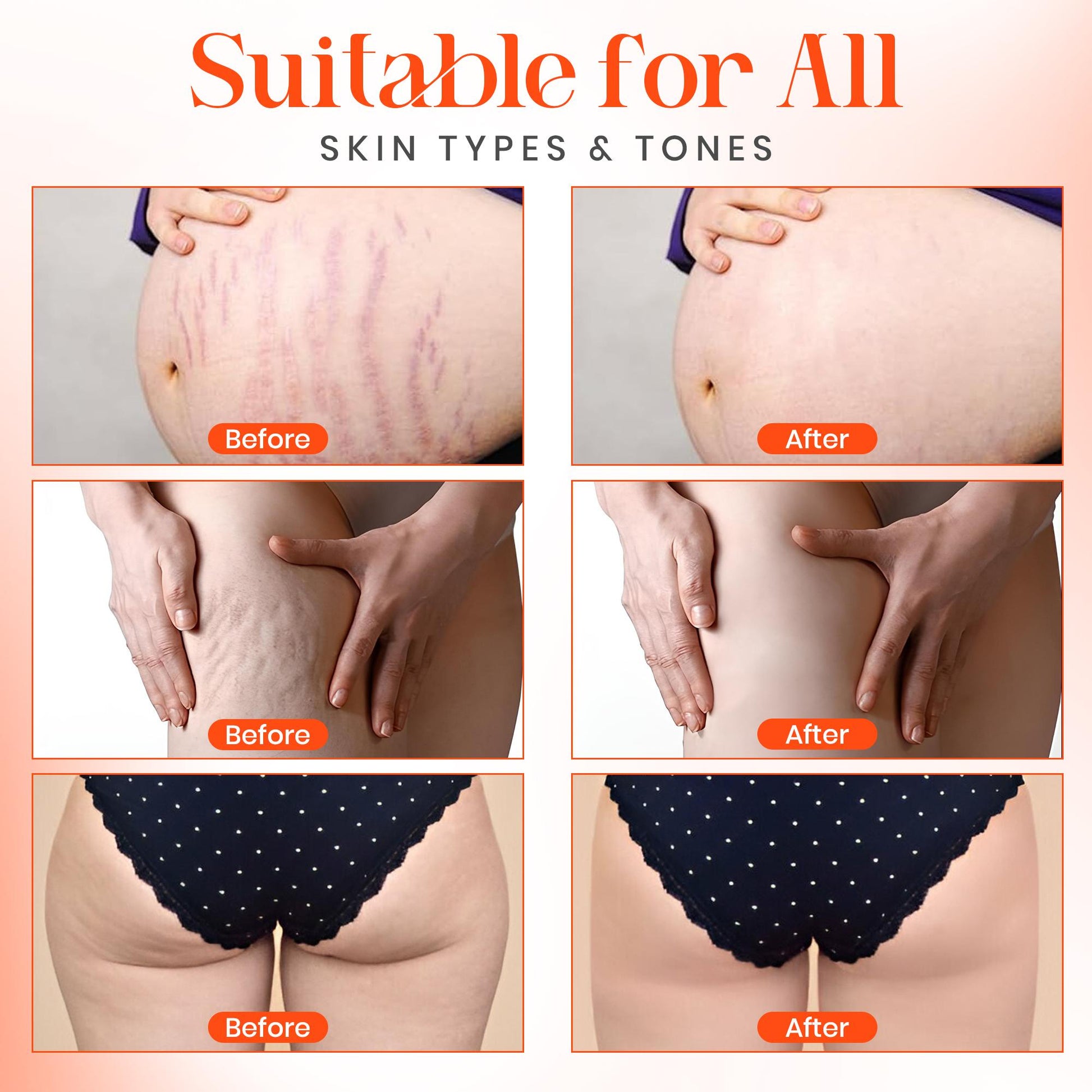 Stretch mark remover oil-2