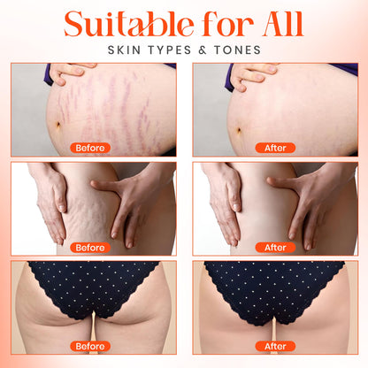 Stretch mark remover oil-2